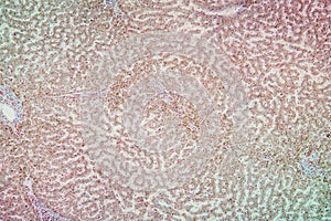 Hemosiderosis tissue