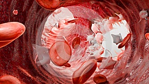 Hemostasis. Red blood cells and platelets in the blood vessel, vasoconstriction, wound healing process. hemorrhage clot