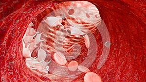 Hemostasis. Red blood cells and platelets in the blood vessel, vasoconstriction, wound healing process. hemorrhage clot