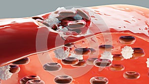 Hemostasis. Red blood cells and platelets in the blood vessel. Basic steps of wound healing process.