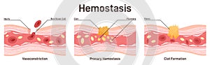 Hemostasis. Wound healing process stages, vasoconstriction and