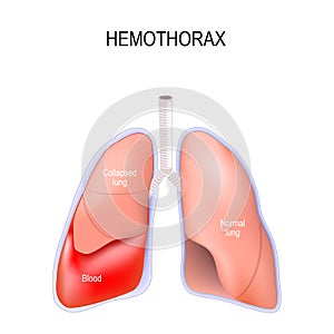 Hemothorax. Collapsed lung photo