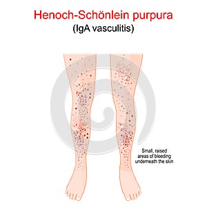 Henoch-SchÃÂ¶nlein purpura. Spotty rash on the humans legs photo