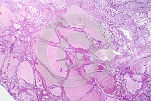 Hepatic cavernous hemangioma