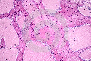 Hepatic cavernous hemangioma