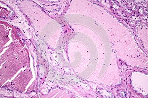 Hepatic cavernous hemangioma photo
