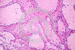 Hepatic cavernous hemangioma photo