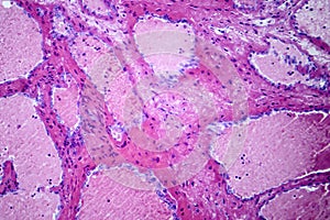 Hepatic cavernous hemangioma, light micrograph photo