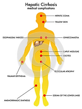 Hepatic cirrhosis photo