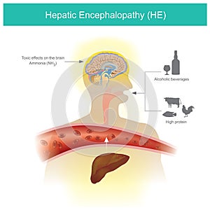 Hepatic Encephalopathy. Protein food or drinking