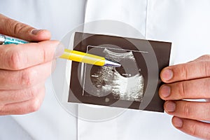 Hepatic or liver cyst on ultrasound image concept photo. Doctor indicating by pen on printed picture ultrasound pathology - hepati photo