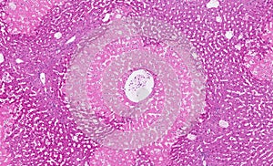 Hepatic necrosis - Liver cell death