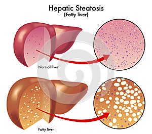 Hepatic steatosis photo