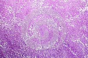 Hepatic steatosis, light micrograph