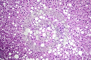 Hepatic steatosis, light micrograph