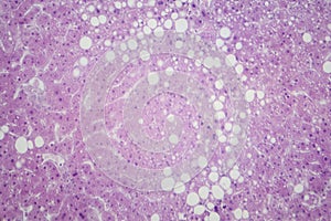 Hepatic steatosis, light micrograph