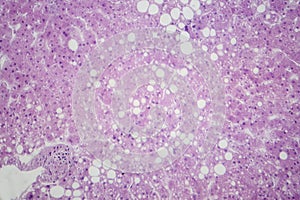 Hepatic steatosis, light micrograph