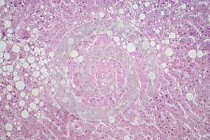 Hepatic steatosis, light micrograph