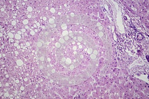 Hepatic steatosis, light micrograph