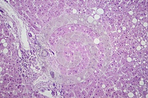 Hepatic steatosis, light micrograph