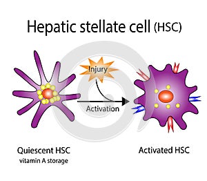 Hepatic stellate cell (HSC), liver fibrosis. vector illustration.