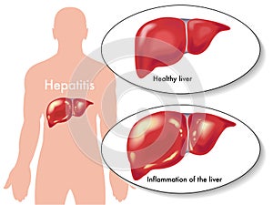 Hepatitis