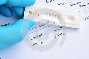 Hepatitis B virus positive test result