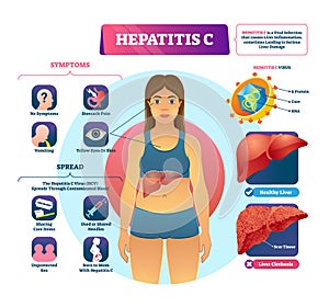Hepatitis C vector illustration. Labeled viral infection explanation scheme