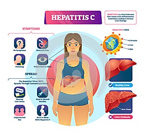 Hepatitis C vector illustration. Labeled viral infection explanation scheme photo