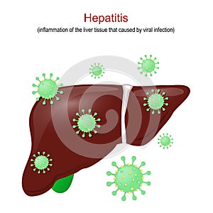 Hepatitis. inflammation of the liver tissue photo