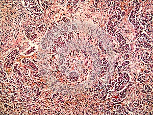 Hepatocellular cancer of liver of a human photo
