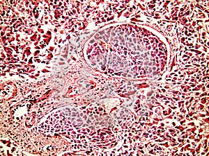 Hepatocellular cancer of liver of a human