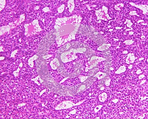 Hepatocellular carcinoma of a human photo