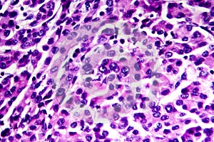 Hepatocellular carcinoma, light micrograph