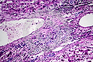 Hepatocellular carcinoma, light micrograph