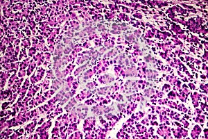 Hepatocellular carcinoma, light micrograph