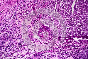 Hepatocellular carcinoma, light micrograph photo
