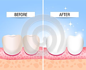 Her teeth sick and a healthy. Visual aid for students, dentists, clinic patients. Defeat is a source of destruction in the teeth.