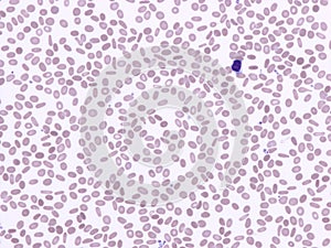 Hereditary elliptocytosis