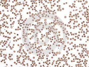 Hereditary spherocytosis. Peripheral blood.