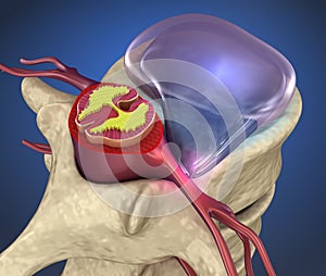 Hernaited  disc in human spine in details