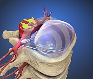 Hernaited  disc in human spine in details