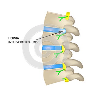 A hernia of the intervertebral disc. Vector illustration on isolated background.