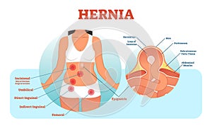 Hernia types vector illustration and cross section of muscle rupture and intestine. photo