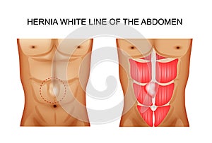 Hernia white line of the abdomen 2