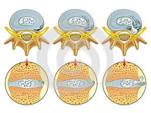 Herniated disc