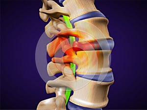 A herniated disc. Also called bulged, slipped or ruptured.