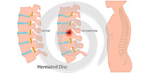 Herniated disc is also known as a slipped