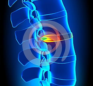 Herniated Disc Degeneration - Spine problem