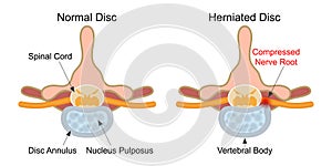Herniated disc is a fragment of the disc nucleus